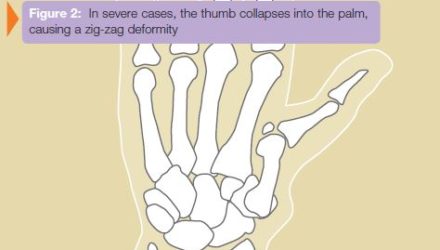 Thumb Basal Joint Arthritis