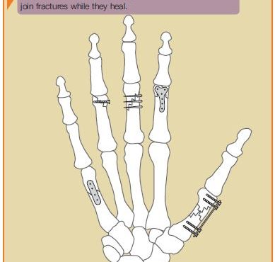 Fractures in the Hand