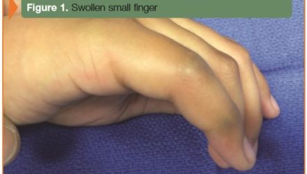 Jammed Finger