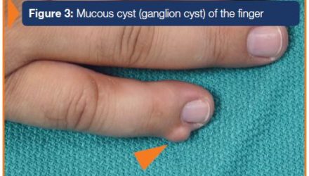 Tumors in the Hand