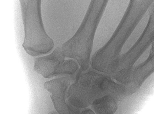 Scaphoid Non-Displaced – Franko