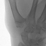 Thumb Arthritis – Franko