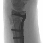 Distal Radius Osteotomy - Franko