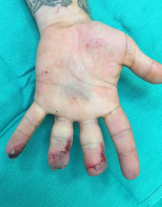 Finger Crush Franko East Bay Hand Medical Center Best Hand Surgeons