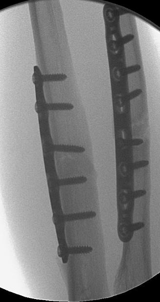 Radius/Ulna ORIF – Expert Hand Surgeons in the East Bay