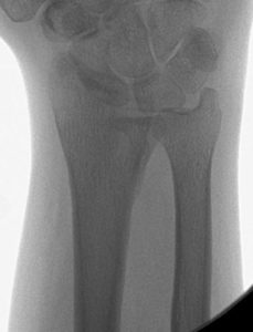 Lunate Facet Malunion with Osteotomy